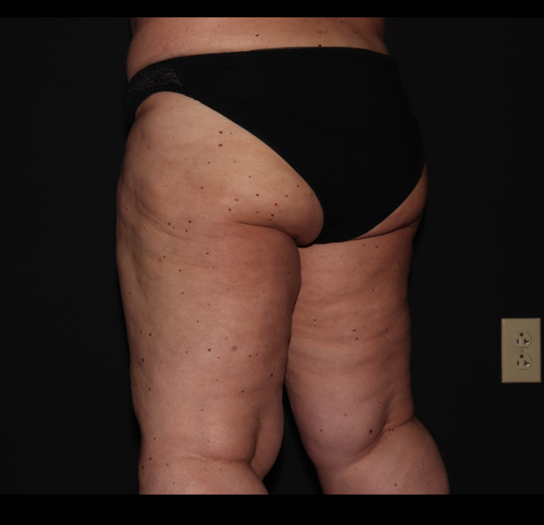 After Image: Hips and Buttocks - left-back-oblique