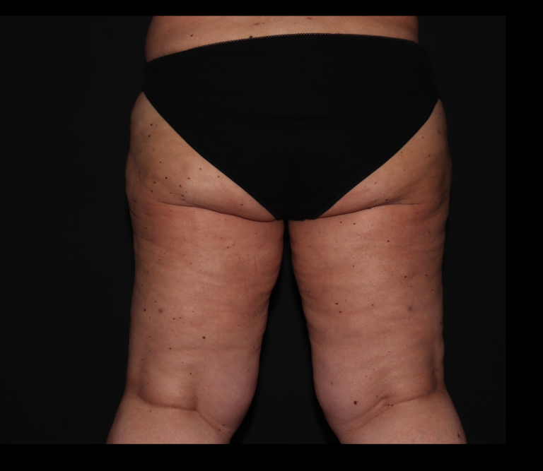 After Image: Hips and Buttocks - back