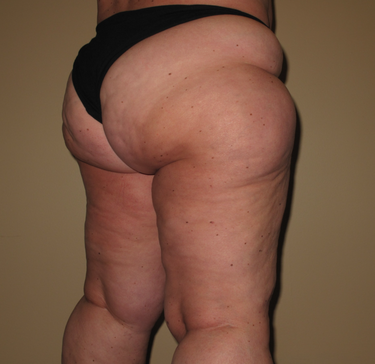 Before Image: Hips and Buttocks - right-back-oblique
