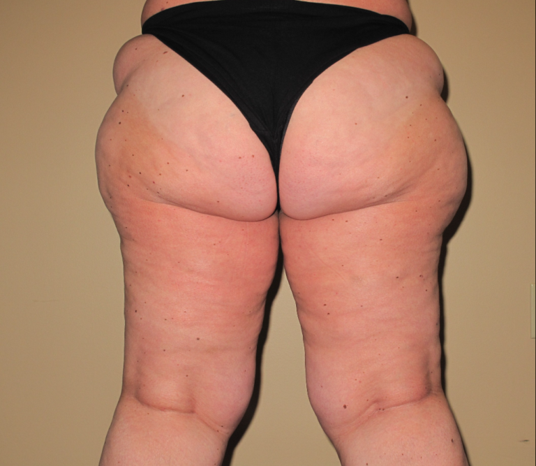 Before Image: Hips and Buttocks - back