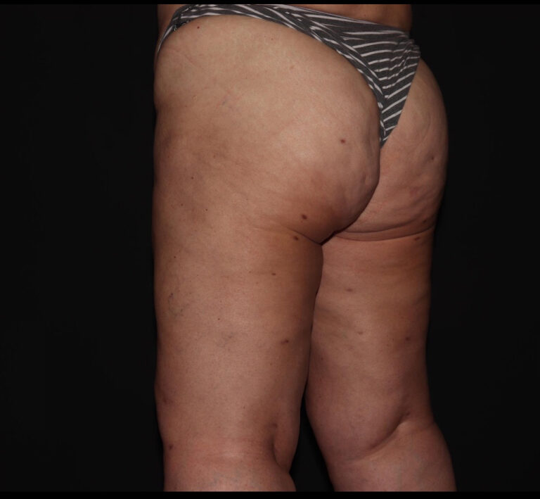 After Image: Hips and Buttocks - left-back-oblique