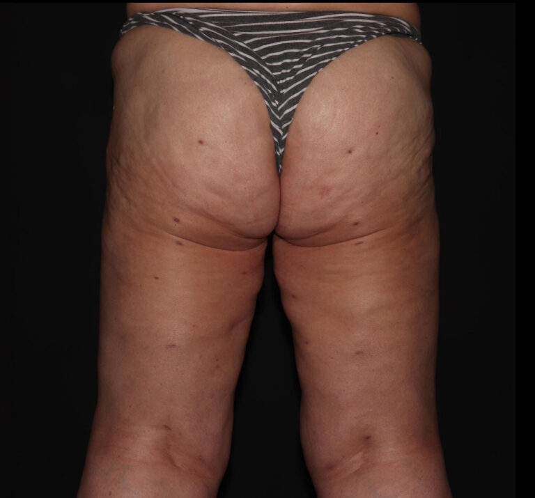 After Image: Hips and Buttocks - back