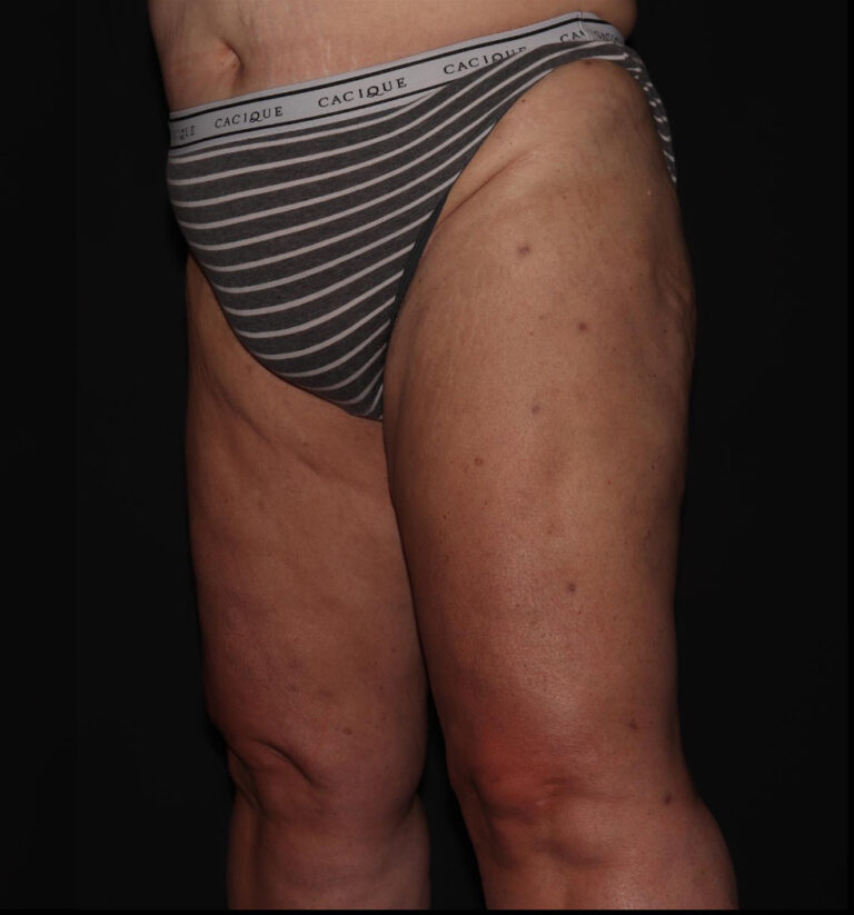 After Image: Hips and Buttocks - left-front-oblique