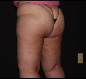 Before Image: Hips and Buttocks