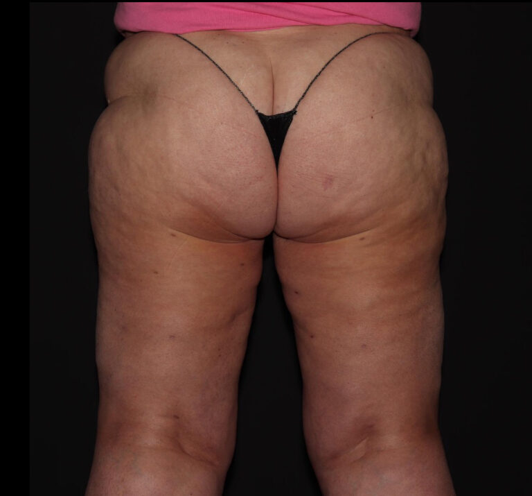 Before Image: Hips and Buttocks - back