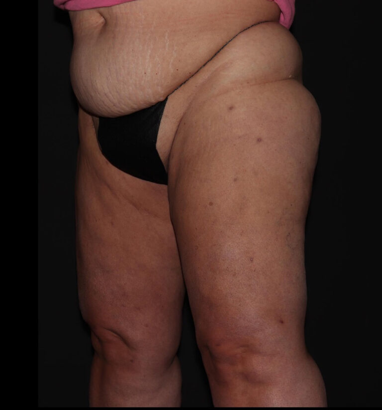 Before Image: Hips and Buttocks - left-front-oblique