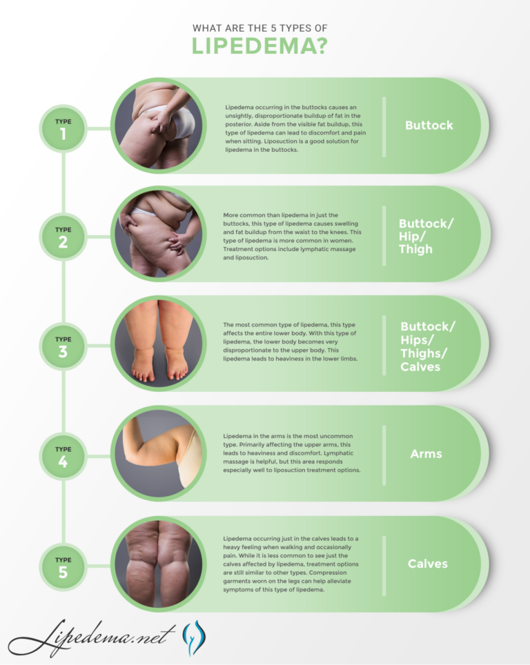 » Lipedema Standard of Care Guidelines - Lipedema