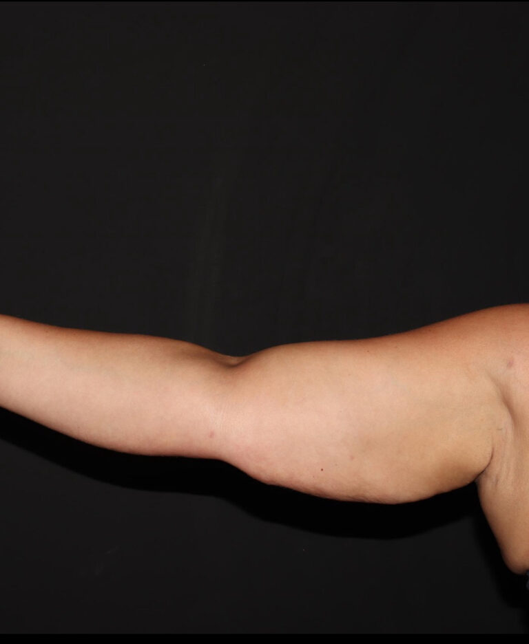After Image: Arms - front