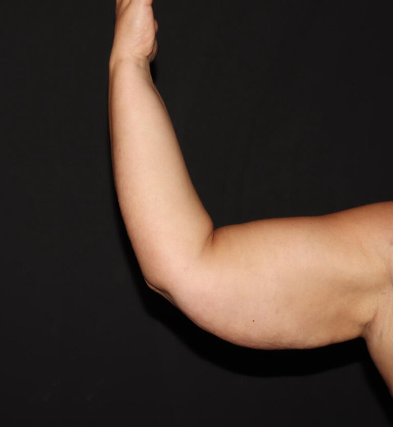 After Image: Arms - front