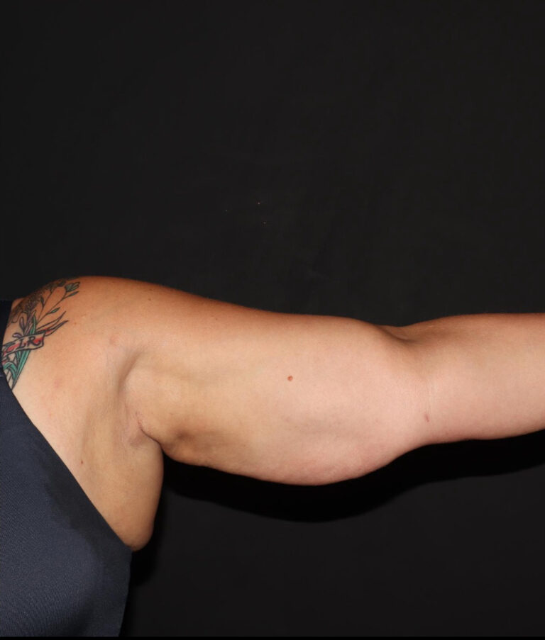 After Image: Arms - front
