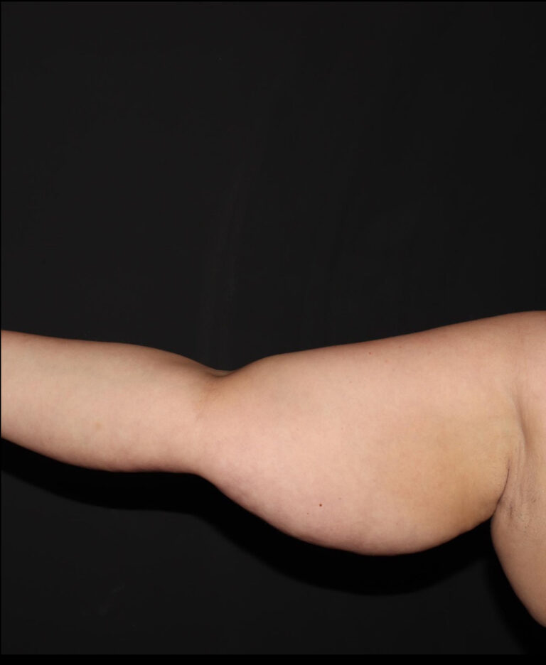 Before Image: Arms - front