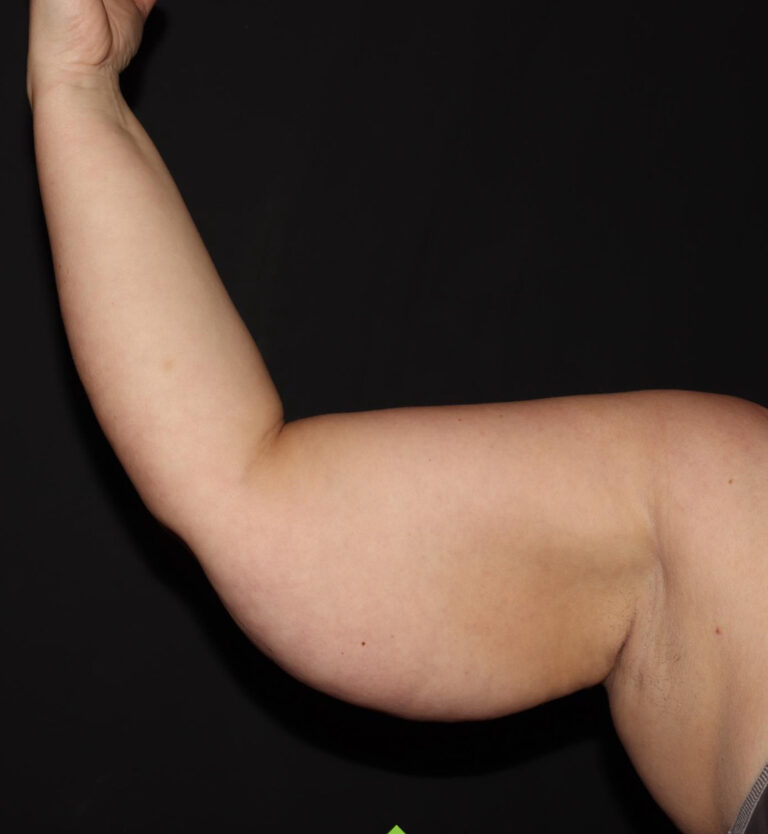 Before Image: Arms - front
