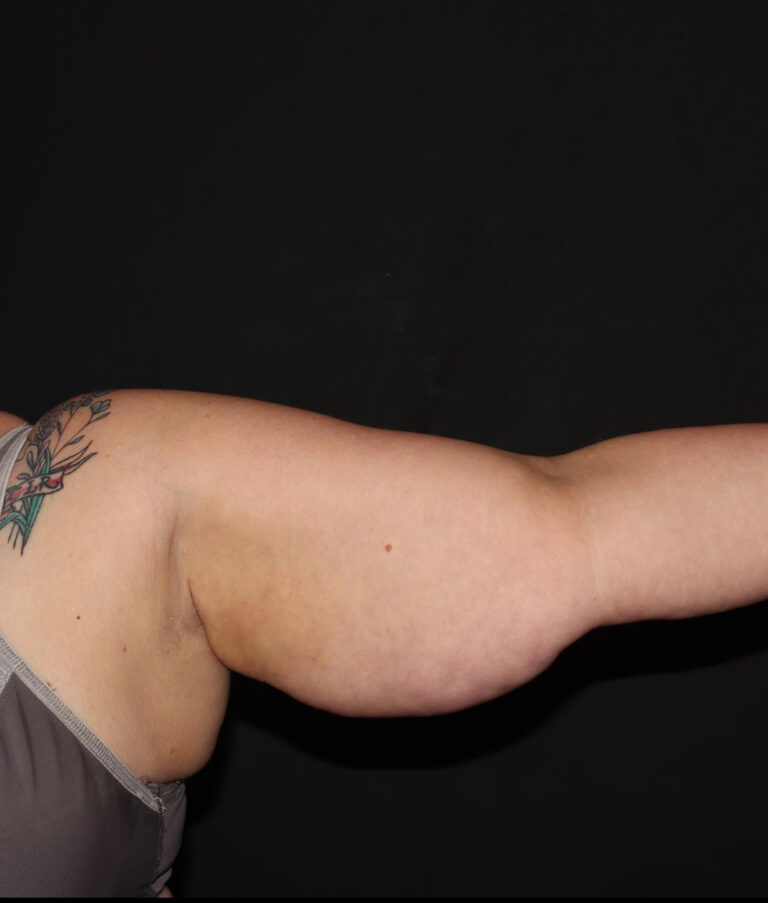 Before Image: Arms - front