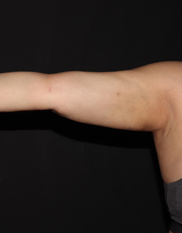 After Image: Arms - front