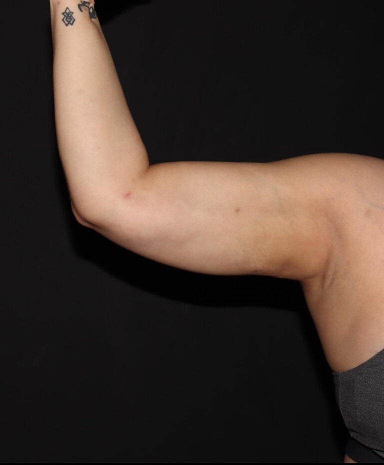 After Image: Arms - front