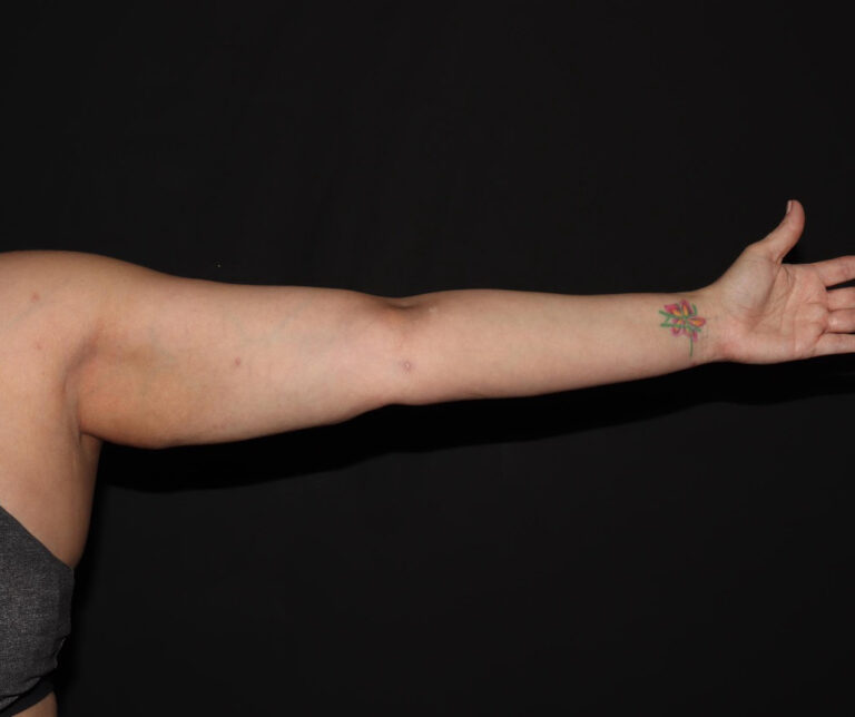 After Image: Arms - front