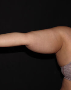 Before Image: Arms