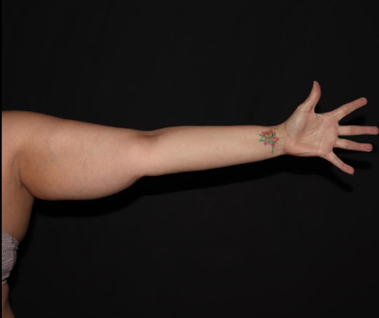 Before Image: Arms - front
