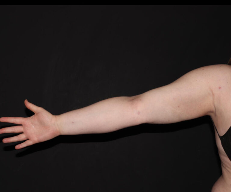 After Image: Arms - front
