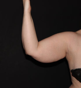 Before Image: Arms