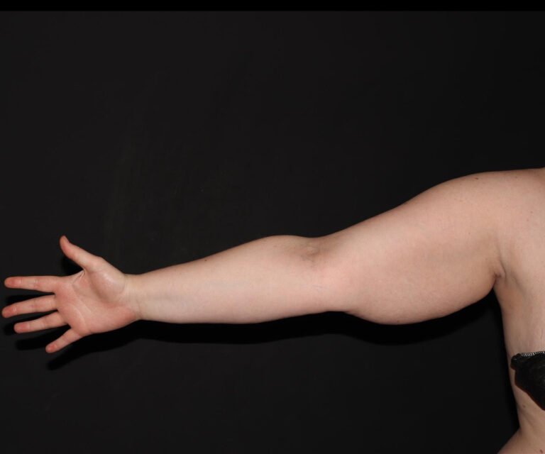 Before Image: Arms - front
