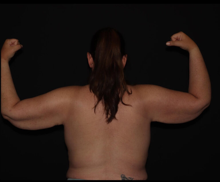After Image: Arms - back