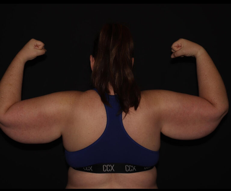 Before Image: Arms - back