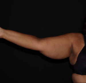 Before Image: Arms