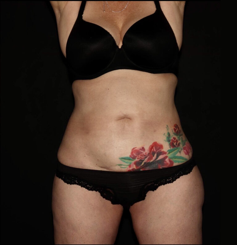 After Image: Abdomen/Flanks - front