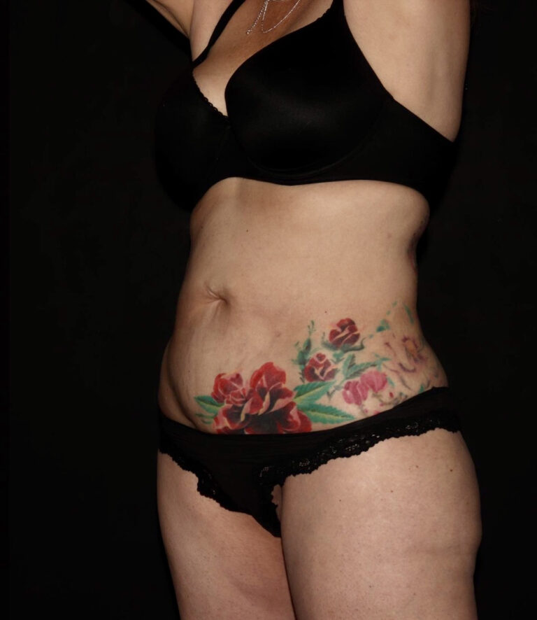 After Image: Abdomen/Flanks - left-front-oblique