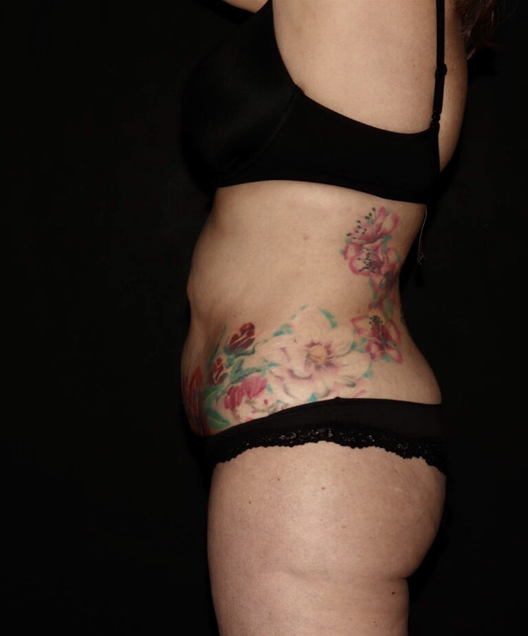 After Image: Abdomen/Flanks - left-side