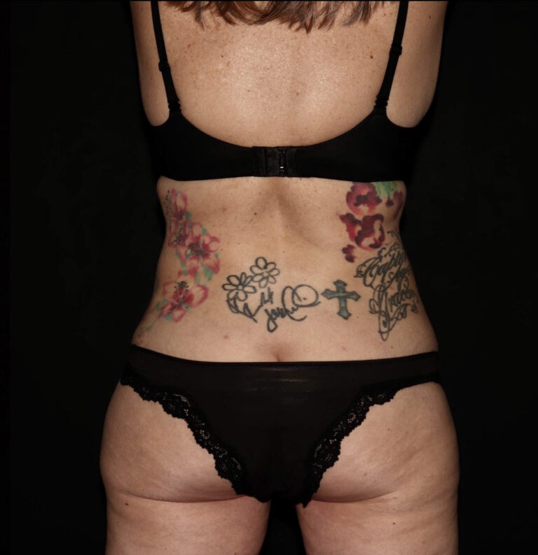 After Image: Abdomen/Flanks - back