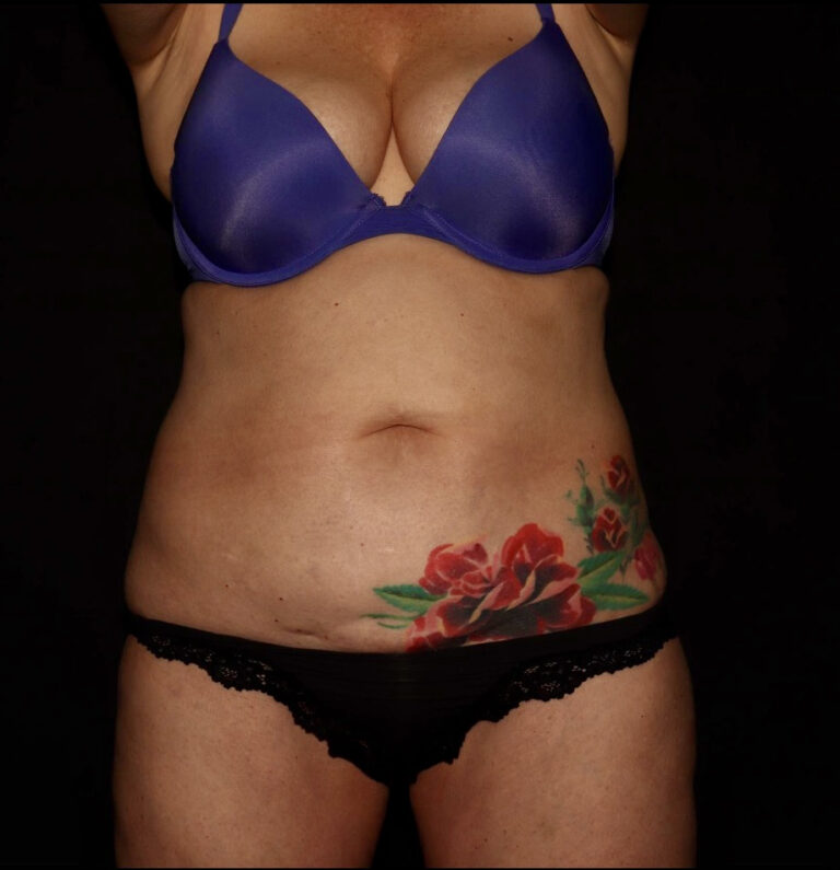 Before Image: Abdomen/Flanks - front