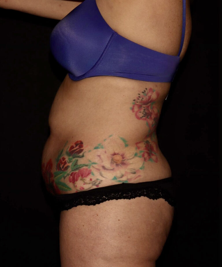 Before Image: Abdomen/Flanks - left-side