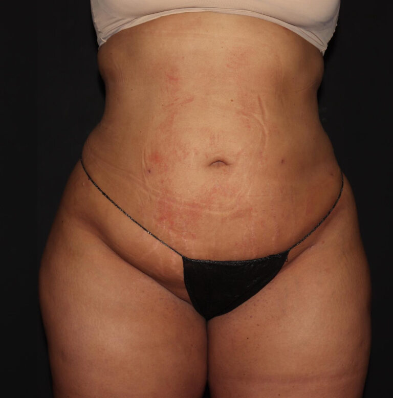 After Image: Abdomen/Flanks - front