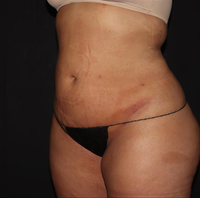 After Image: Abdomen/Flanks - left-front-oblique