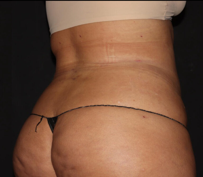 After Image: Abdomen/Flanks - right-back-oblique