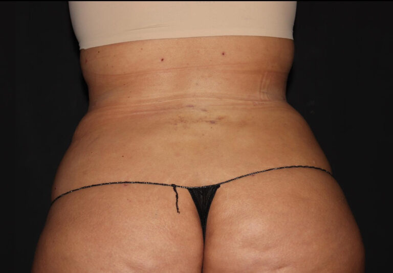 After Image: Abdomen/Flanks - back