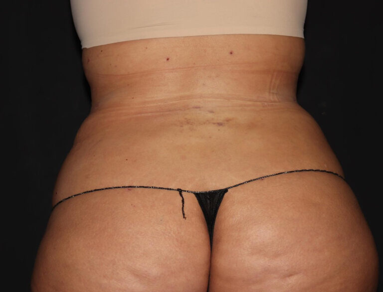 After Image: Abdomen/Flanks - back