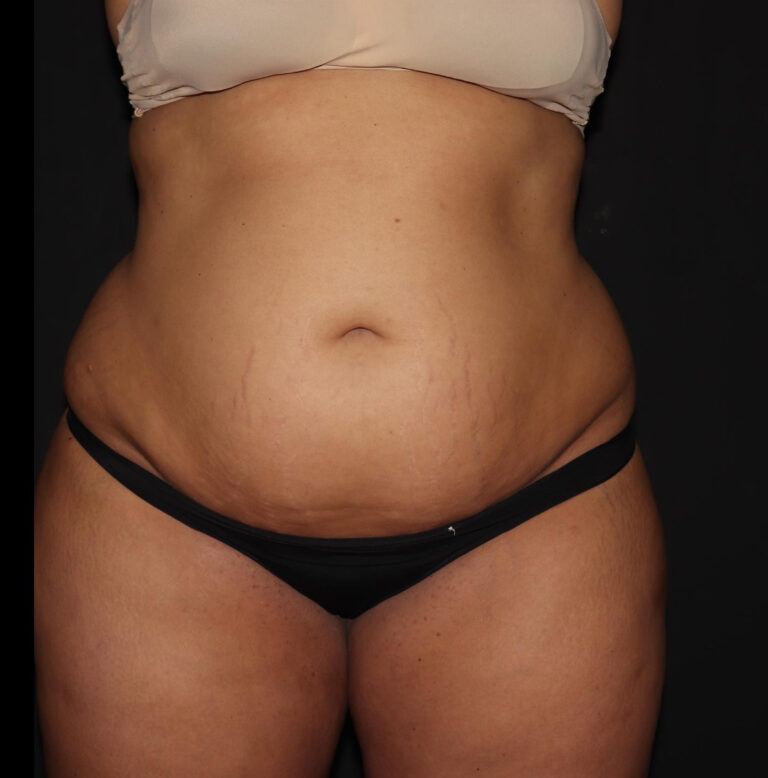 Before Image: Abdomen/Flanks - front