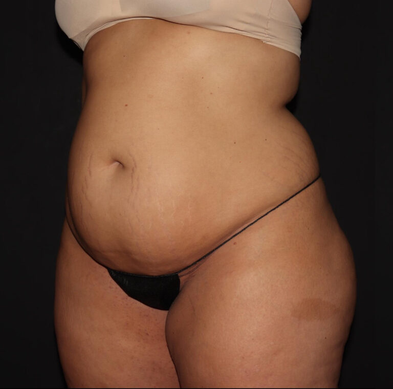 Before Image: Abdomen/Flanks - left-front-oblique