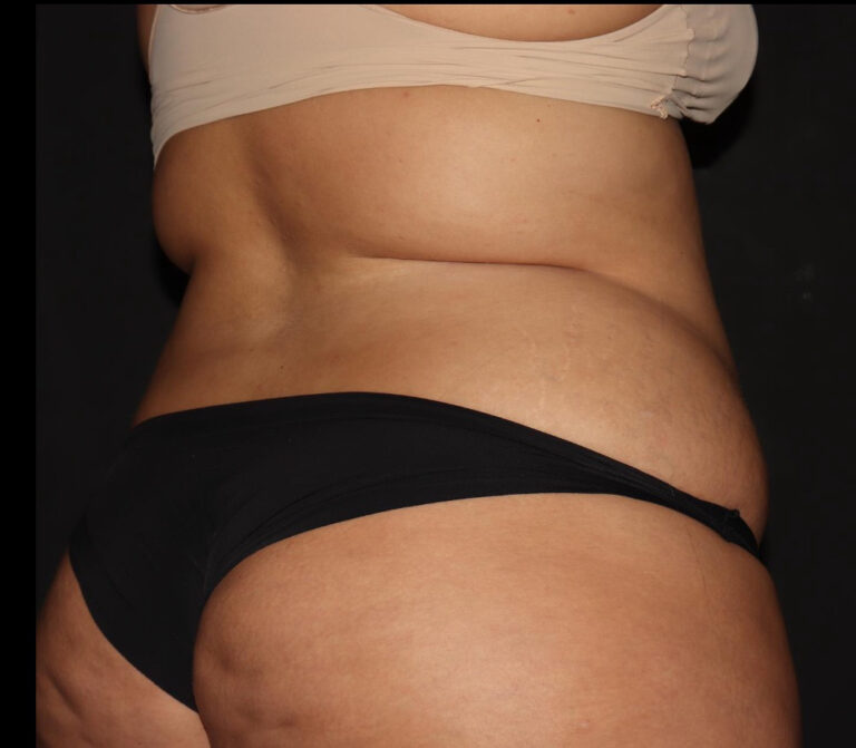 Before Image: Abdomen/Flanks - right-back-oblique