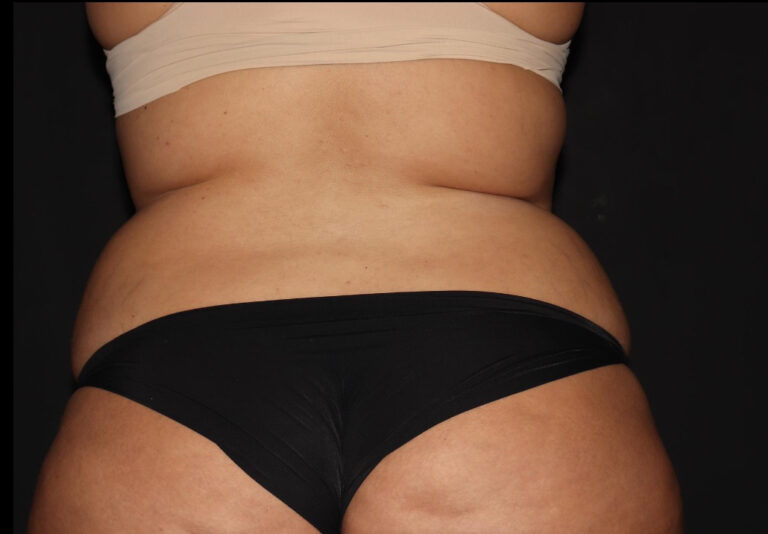 Before Image: Abdomen/Flanks - back