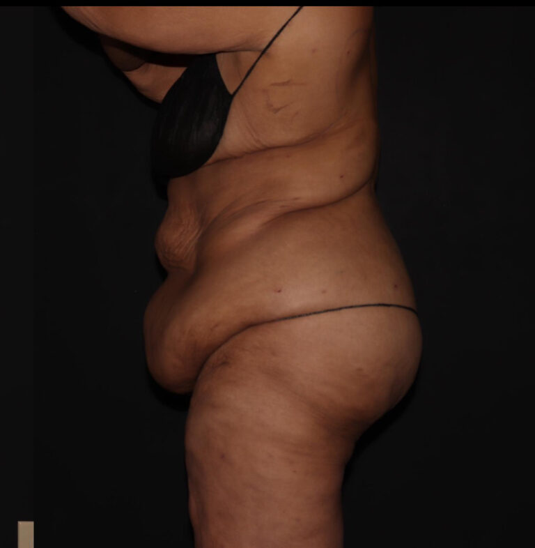 After Image: Abdomen/Flanks - left-side