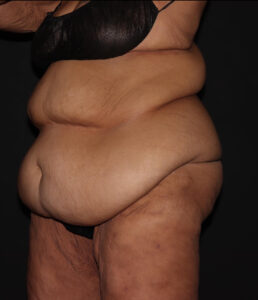 Before Image: Abdomen/Flanks