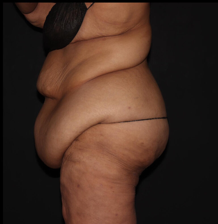 Before Image: Abdomen/Flanks - left-side