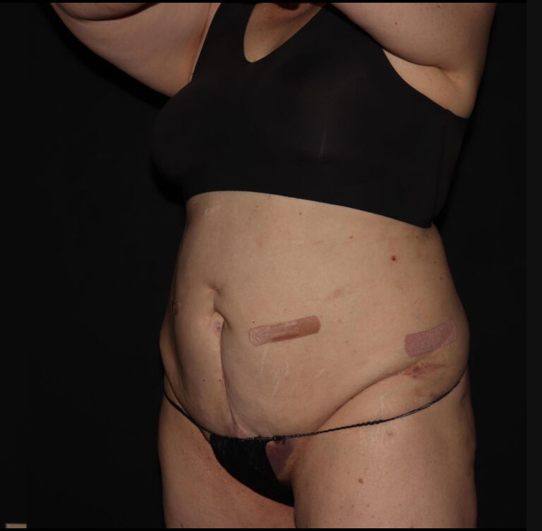 After Image: Abdomen/Flanks - left-front-oblique