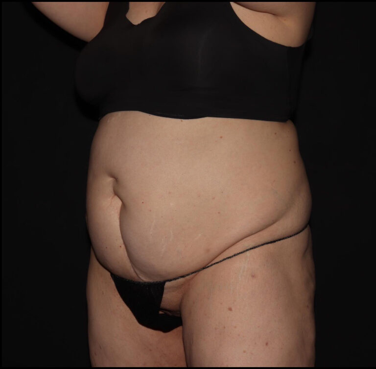 Before Image: Abdomen/Flanks - left-front-oblique