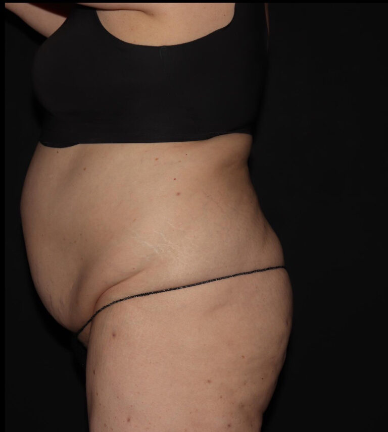 Before Image: Abdomen/Flanks - left-side