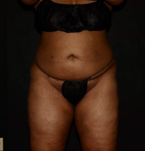 After Image: Abdomen/Flanks